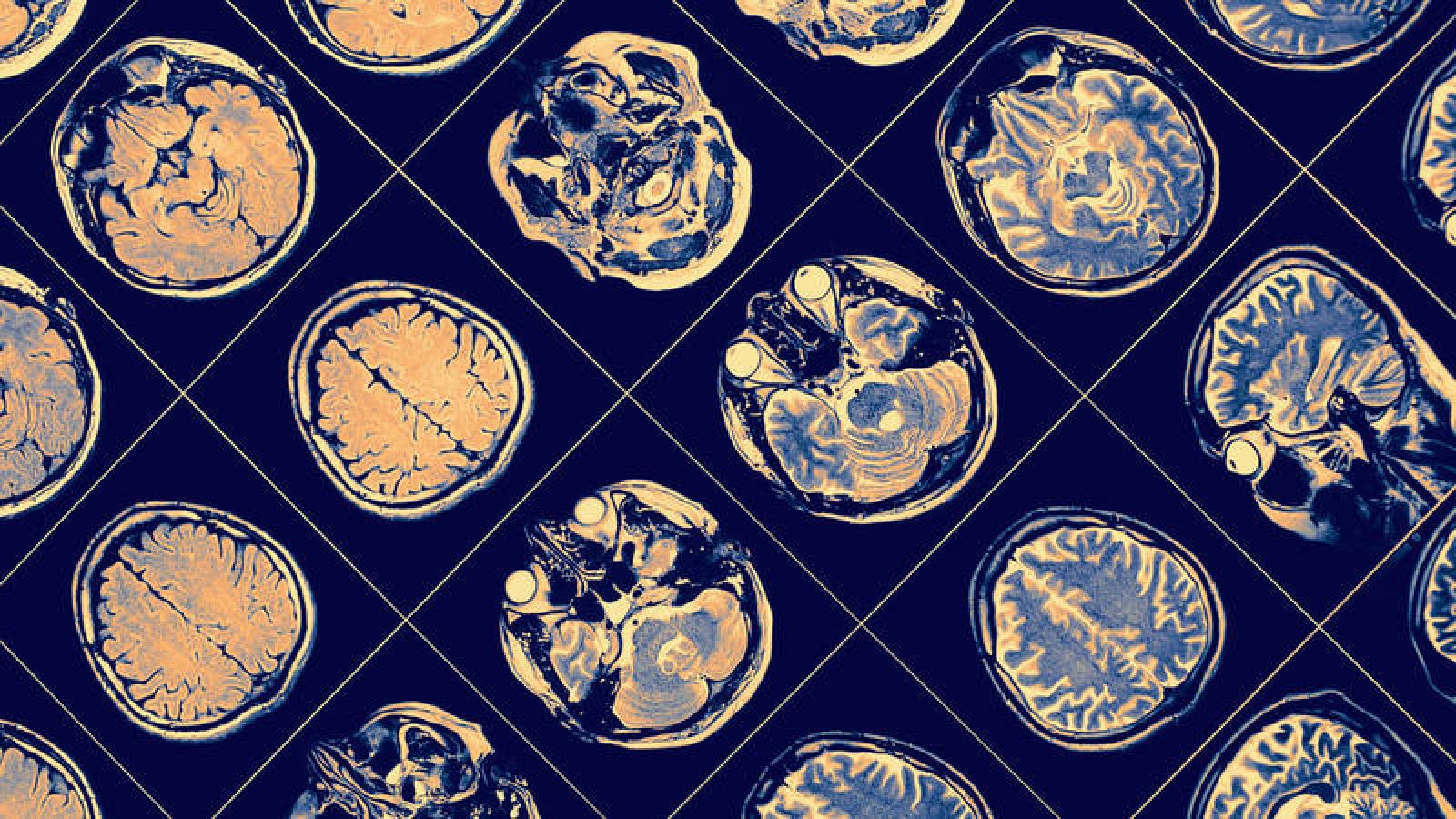 La acumulación en el cerebro de placas de proteína beta amiloide es una de las lesiones neurodegenerativas más características del alzhéimer