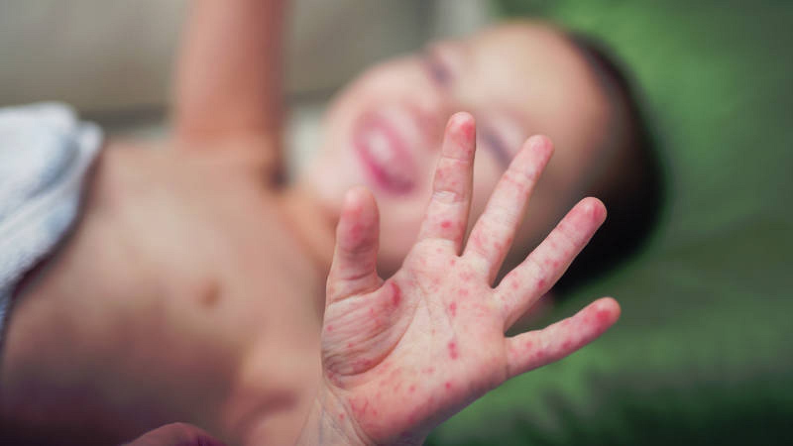 Los pediatras recuerdan que para proteger a los niños del sarampión son "esenciales" dos dosis de la vacuna.