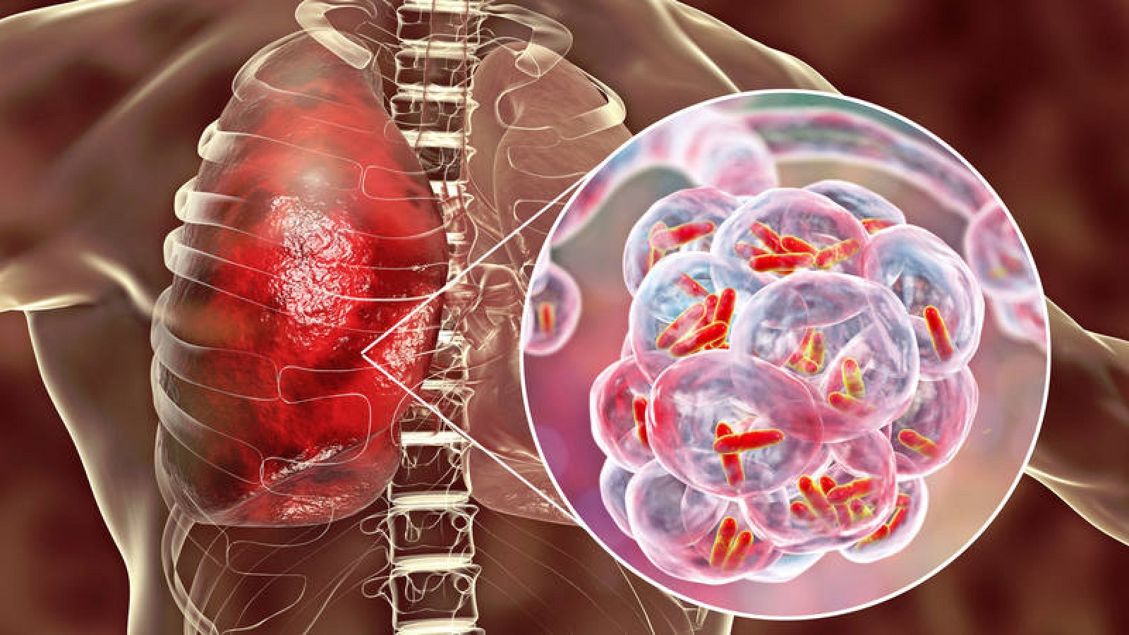 Tuberculosis: Consiguen descifrar el mecanismo infeccioso más
