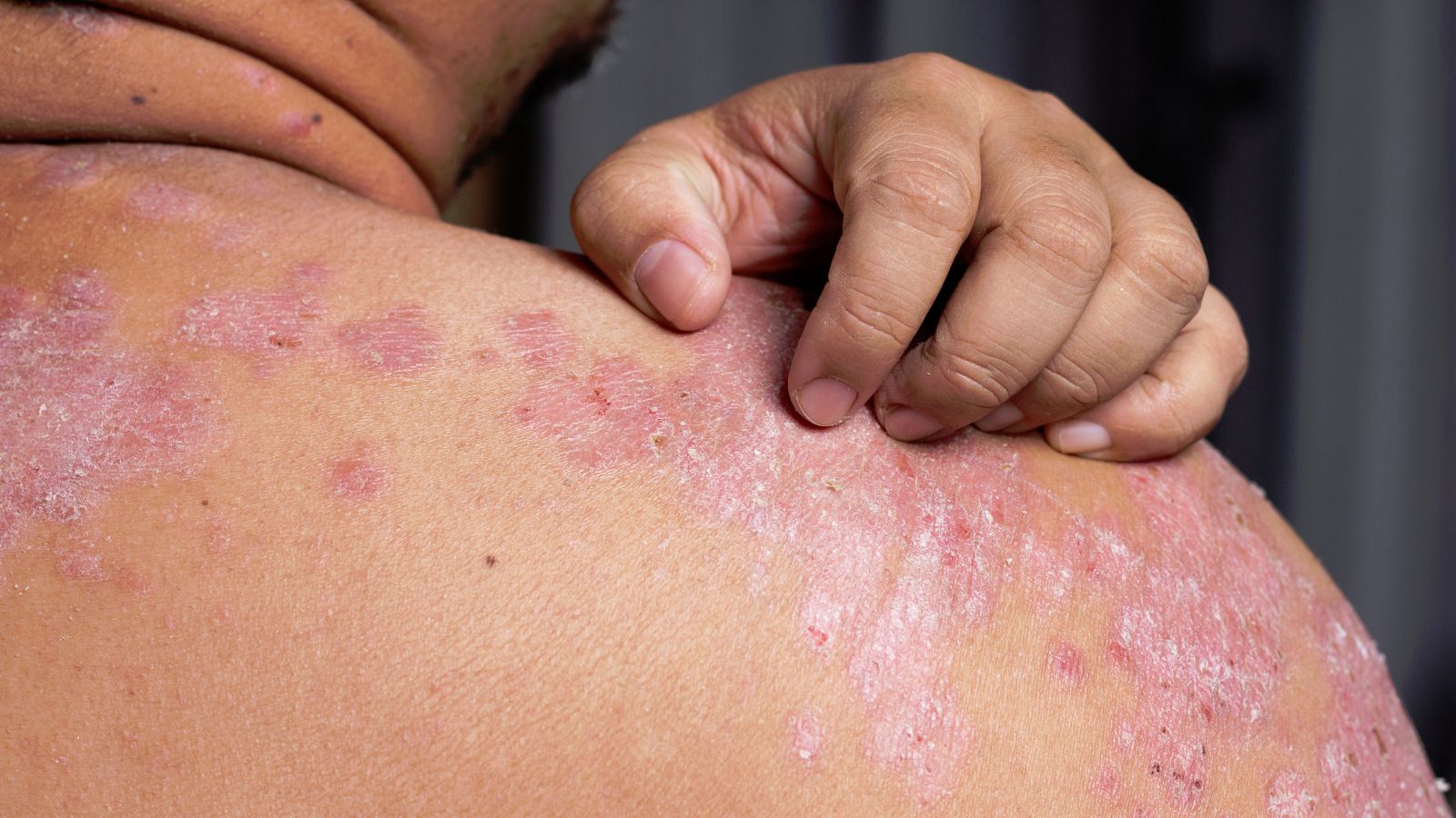 Cerca de un millón de personas en España padece psoriasis.