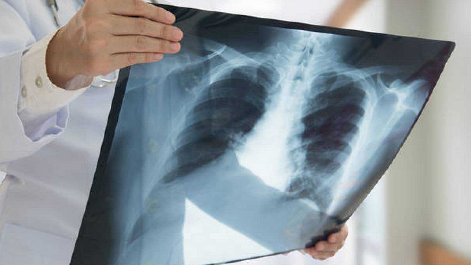 Un estudio de científicos españoles demuestran la eficacia de la inmunoterapia en pacientes con cáncer de pulmón