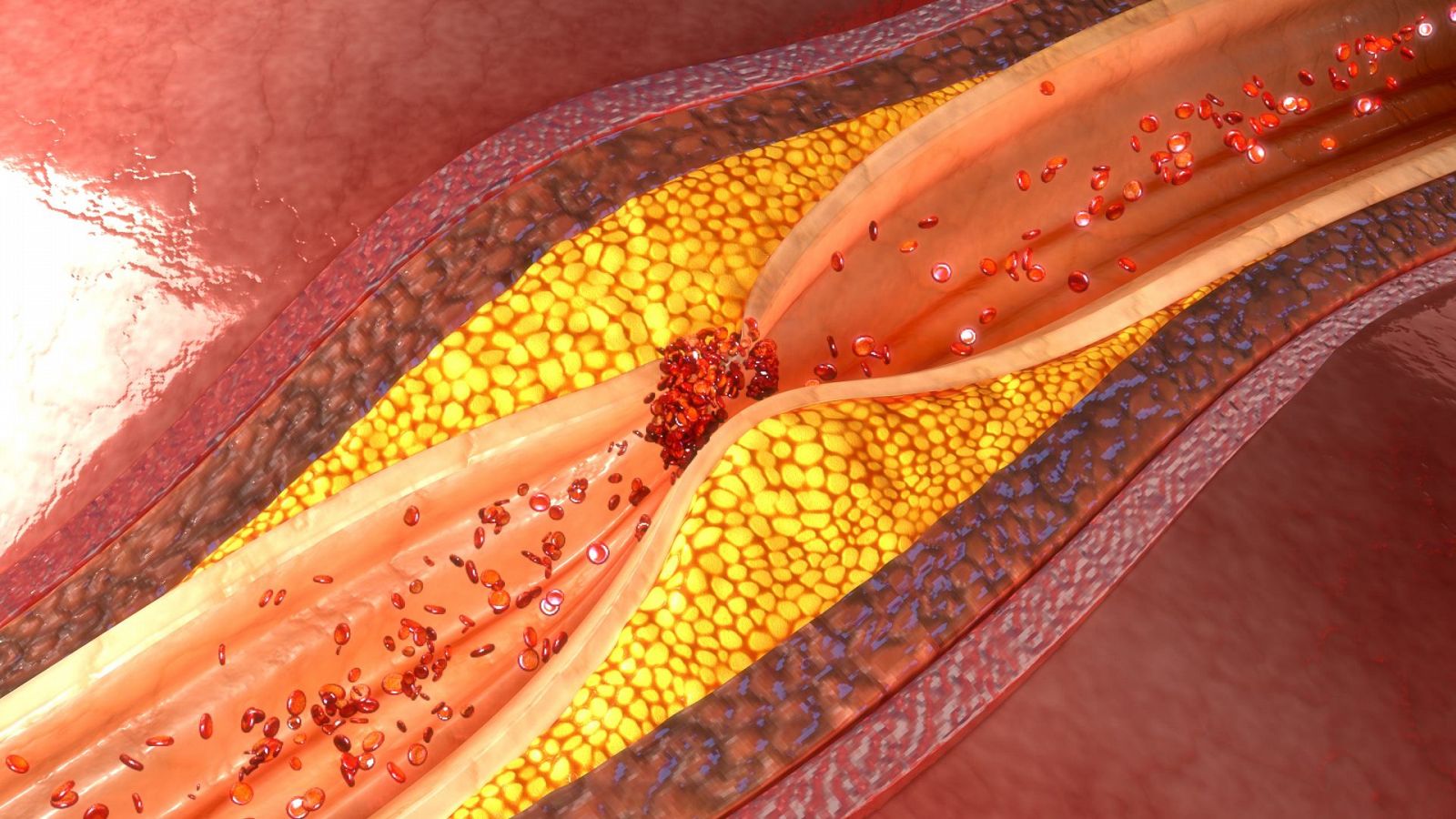 Recreación de una obstrucción arterial por colesterol