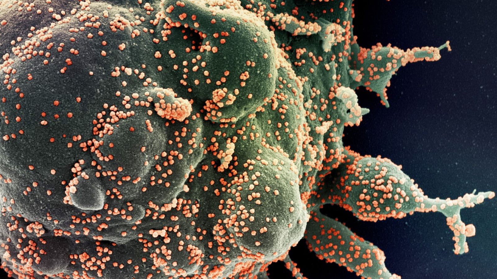 Micrografia acolorida d'una cèl·lula fortament infectada (verda) amb partícules del virus SARS-COV-2 (taronja)