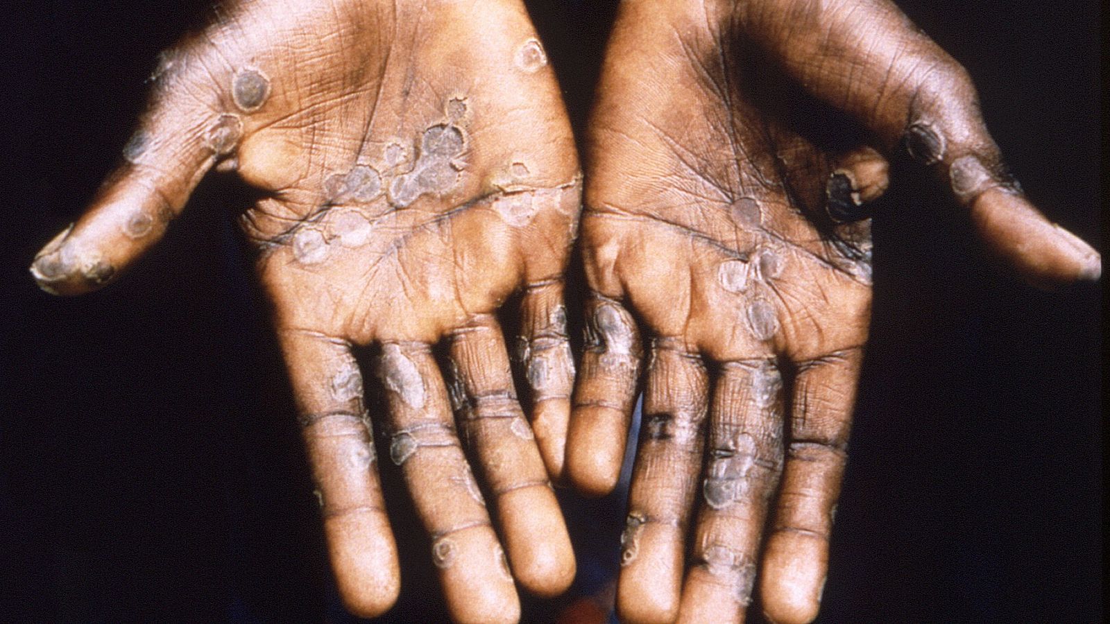 La viruela del mono se considera una enfermedad endémica de República Democrática del Congo.