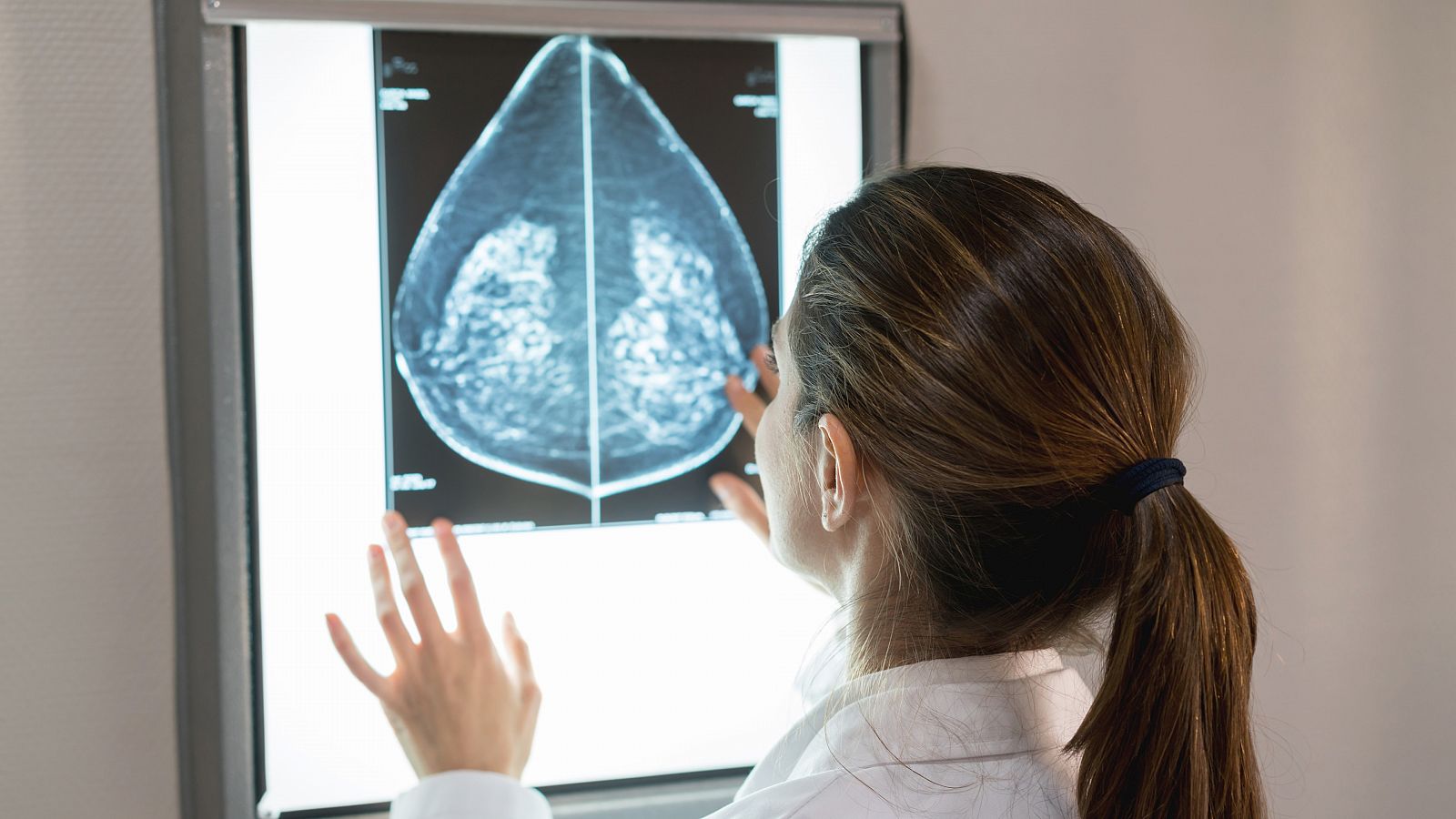 El cáncer de mama es el tumor más frecuente en mujeres en todo el mundo.