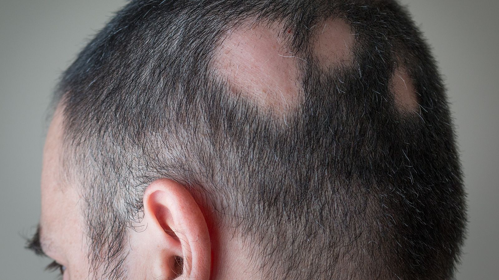 La alopecia areata es una enfermedad de naturaleza autoinmune.