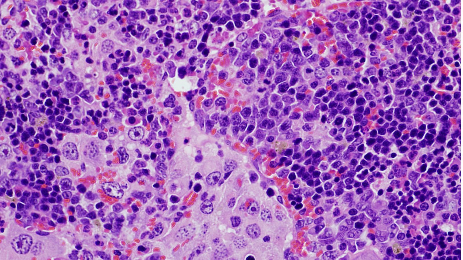 Imagen de microscopía de un bazo que presenta un linfoma desarrollado por ratones que expresan una mutación oncogénica en el gen VAV1