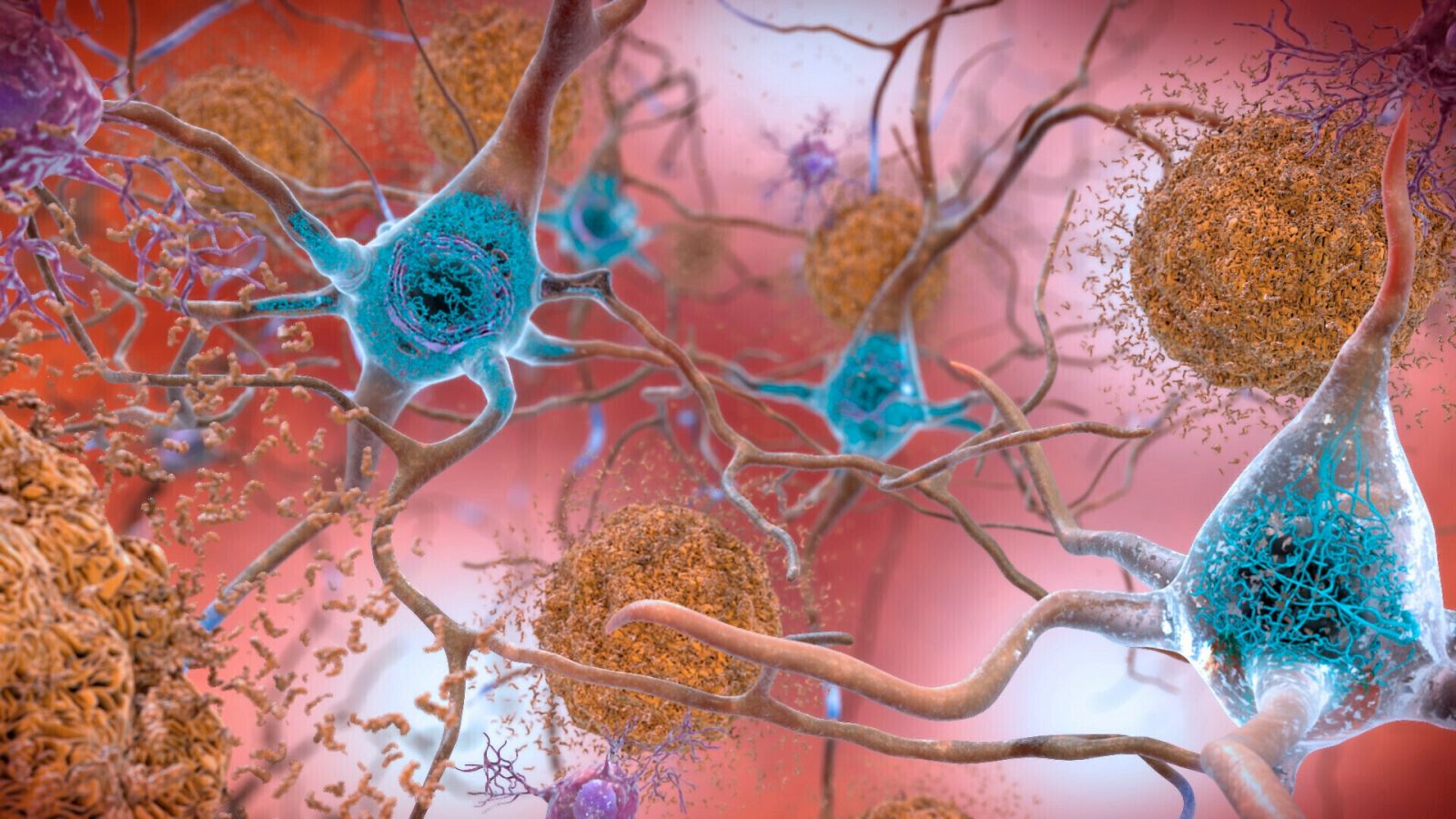 Representación de una estructura cerebral afectada por alzhéimer.