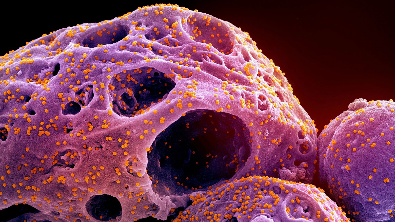 Kraken, variante ómicron: Imagen obtenida con un microscopio electrónico que muestra células infectadas.