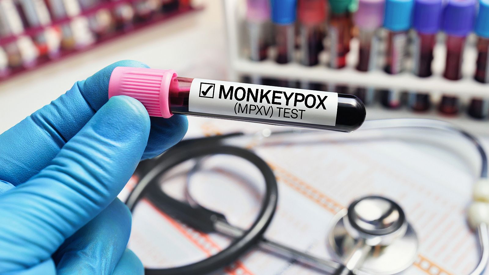 Un médico con una muestra de sangre en un tubo diagnosticado con la enfermedad de la viruela del mono