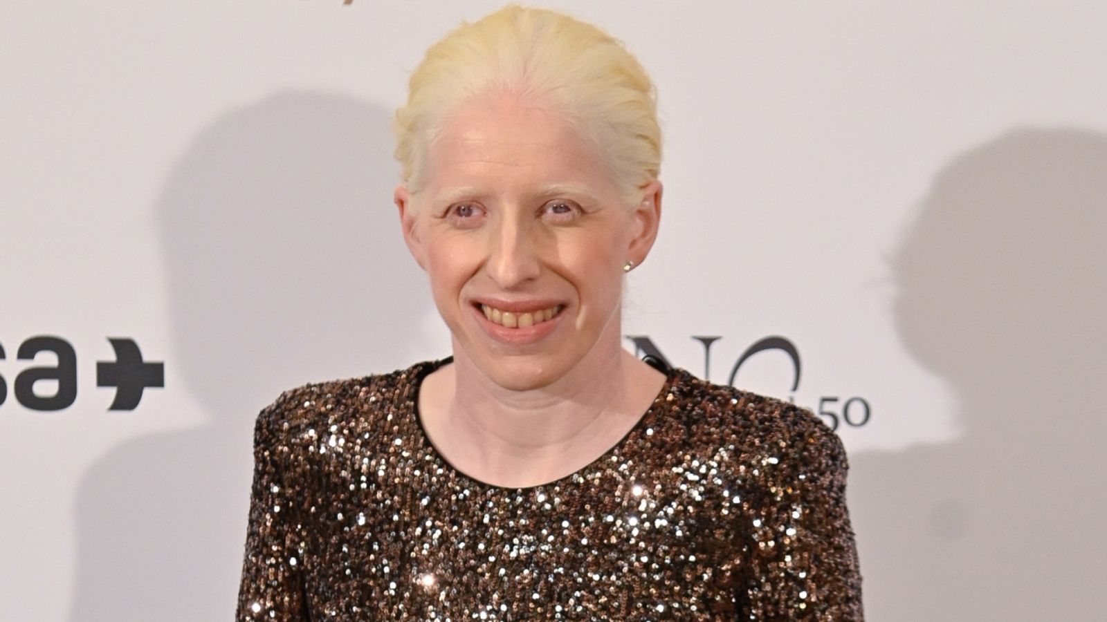 El albinismo es una condición genética que afecta a una de cada 17.000 personas