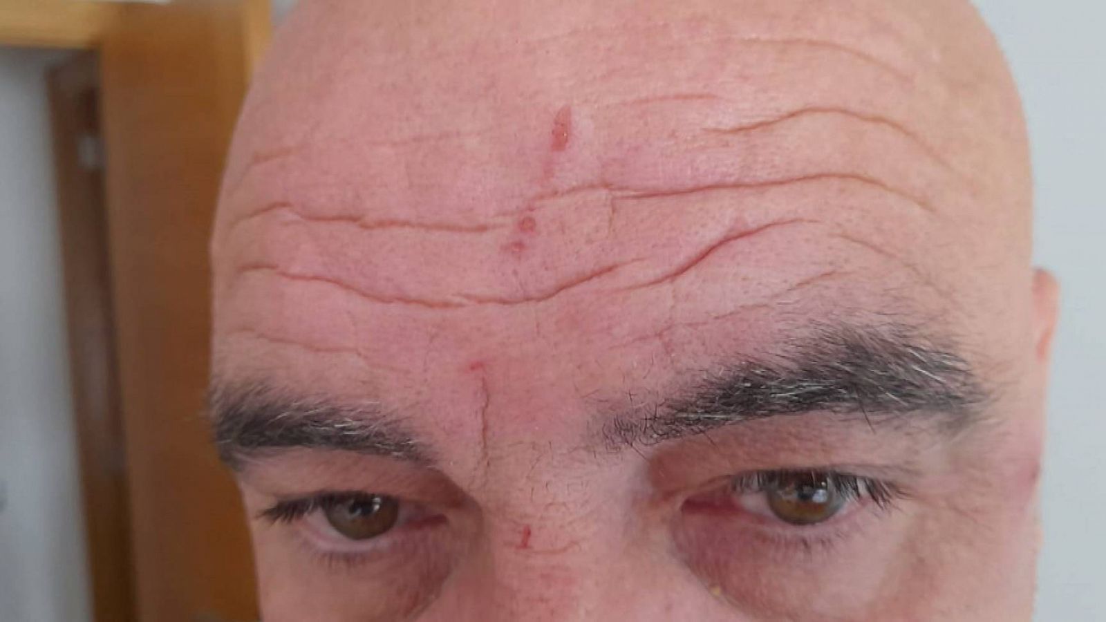 Un hombre muestra una herida en la frente causada por una agresión en su puesto de trabajo
