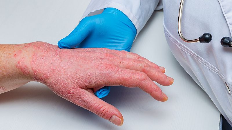 Un médico examina la mano de un paciente con psoriasis.