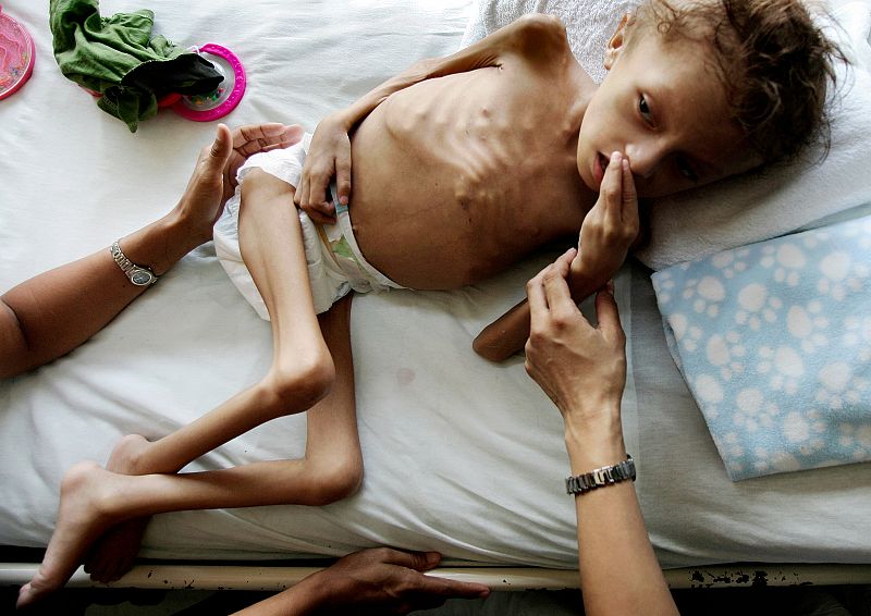 El niños de nueve años Jason López descansa en la cama del hospital Catarino Rivas, en Honduras, con riesgo serio de malnutrición.