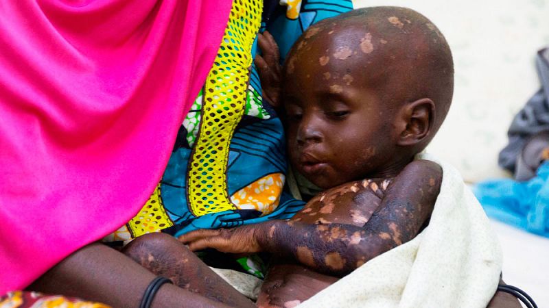 Niño en estado crítico por desnutrición en los brazos de su madre durante su ingreso en el Hospital de Zinder (Níger) donde se recupera.