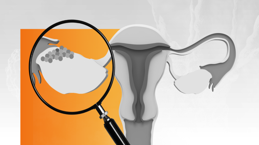 Imagen de cáncer de ovario