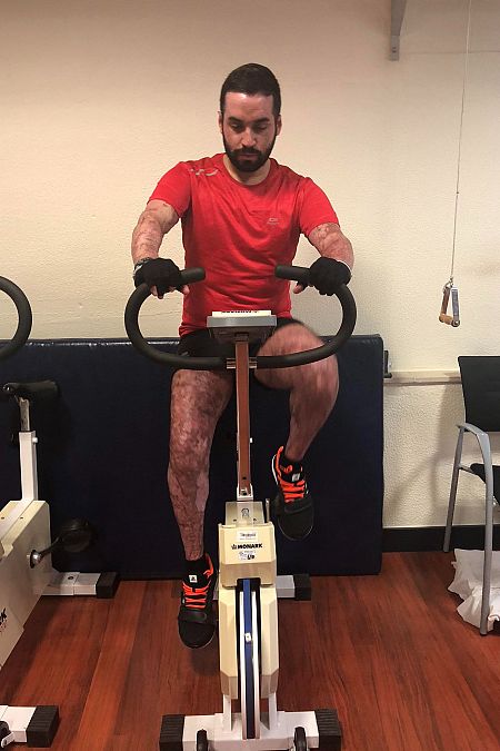 Fran pedalea una bicicleta estática durante su proceso de rehabilitación, con su piel artificial ya implantada.