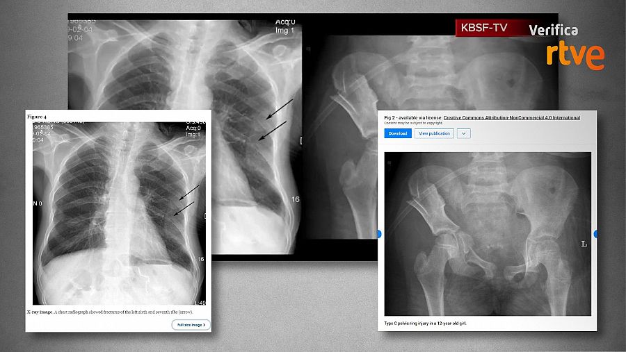 Fotografías de las radiografías que se utilizan en el vídeo publicadas en investigaciones médicas