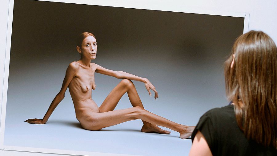 Imagen de una mujer muy delgada sentada desnuda; otra mujer la observa. Fotografía en blanco y negro que busca generar conciencia sobre la anorexia.