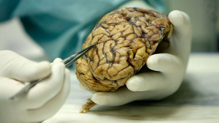 Cerebro humano enfermo de alzhéimer.