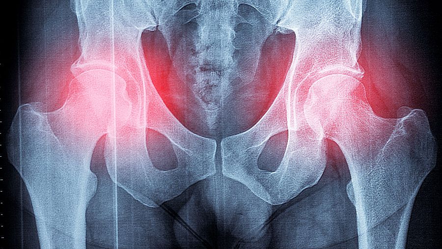 ¿Qué es la osteomielitis pélvica?