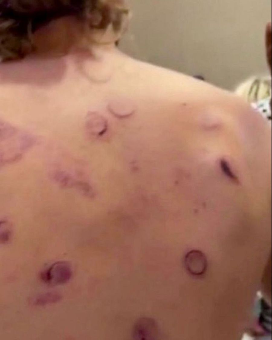 Heridas en la espalda de uno de los participantes en la flotilla Rumbo a Gaza