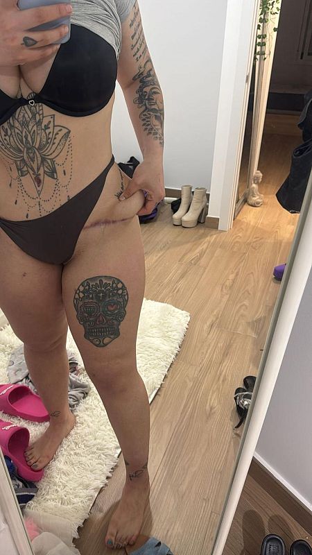 Nerea Irby se hizo en Turquía una lipotransferencia de abdomen a glúteos