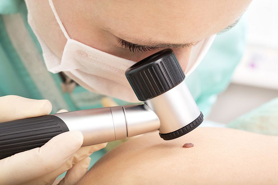 Una dermatóloga examinando un lunar con un dermatoscopio.
