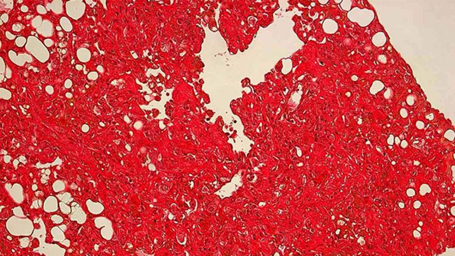 Muestras de pulmón de ratón en las que se observan fibras de colágeno que generan fibrosis pulmonar.