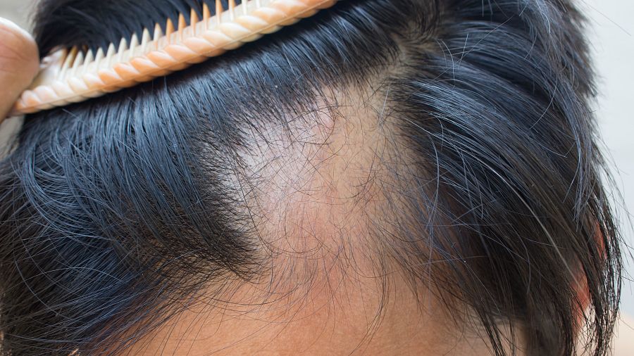 Cabeza con alopecia