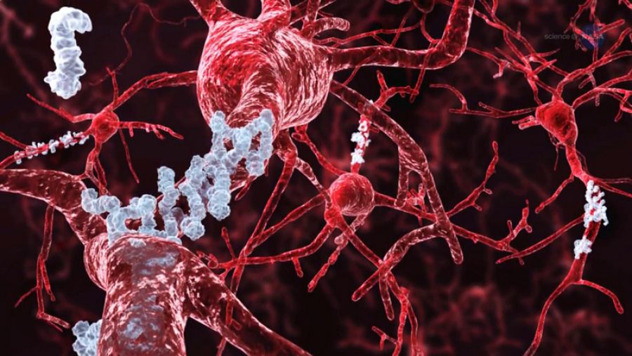 Los investigadores creen que la enfermedad de Alzheimer avanza cuando ciertas proteínas se juntan en el cerebro y forman largas fibras que se acumulan y, finalmente, estrangulan a las neuronas del cerebro