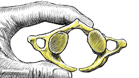 Primera vértebra cervical, llamada atlas, donde se aprecia la anomalía congénita.