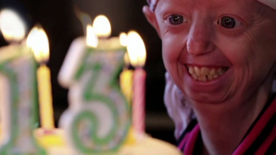 Hayley sufre progeria, una enfermedad rara que le provoca envejecimiento prematuro.