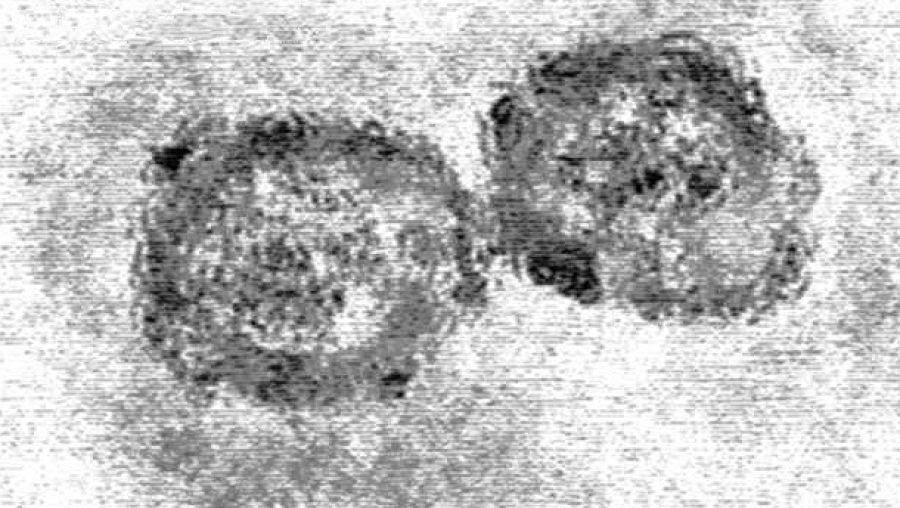 Virus de la hepatitis C.