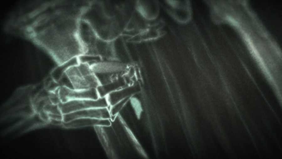 La radiología permite extraer las balas de forma precisa
