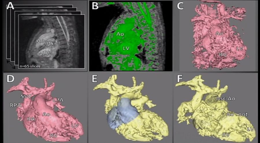 Imágenes de un corazón a partir de resonancias magnéticas