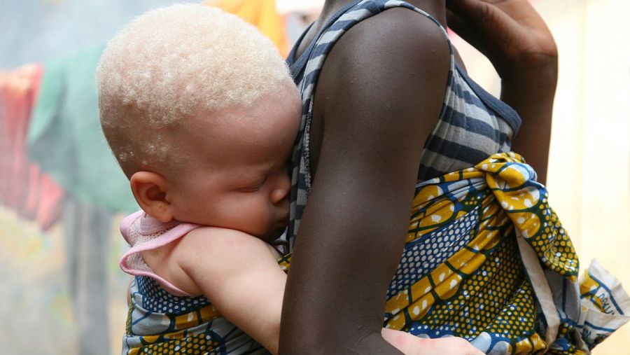 Niño albino en África