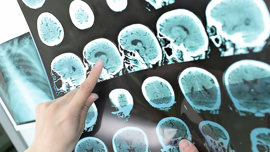 Investigaciones sobre el Alzheimer