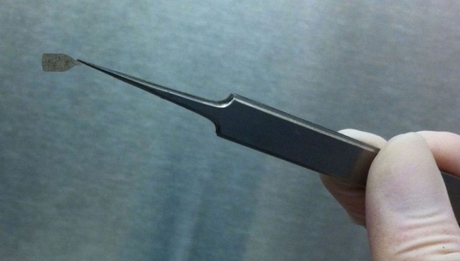 El implante está compuesto por células del epitelio pigmentario de la retina (EPR). B.O. PENNINGTON