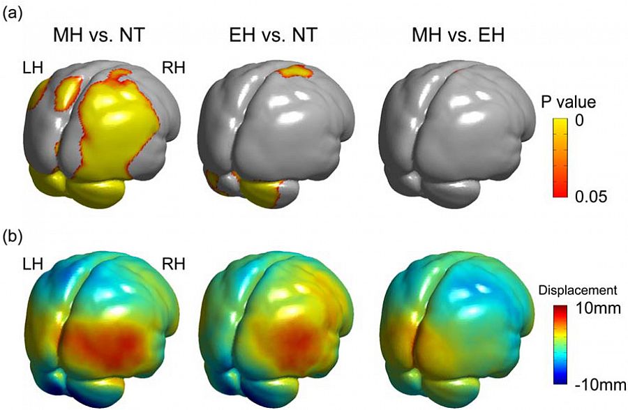 Comparación de la morfología de los cerebros de los neandertales (NT), los humanos modernos (MH) y los primeros H. sapiens (EH)