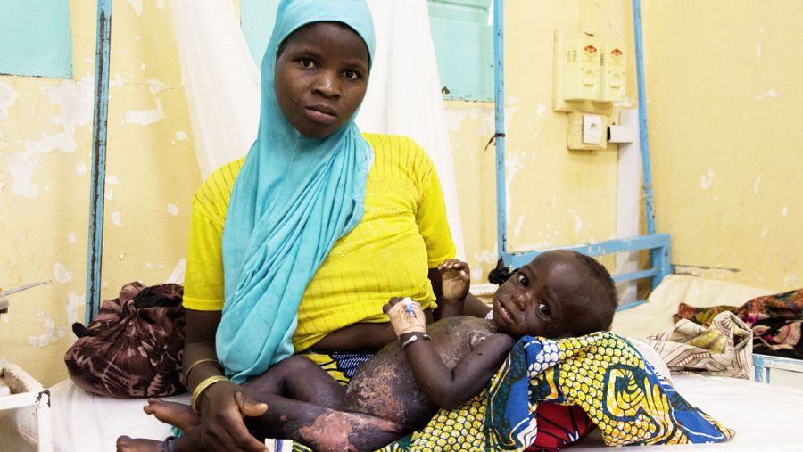 Madre posa con su niño afectado por una desnutrición severa en el hospital de Zinder (Níger)