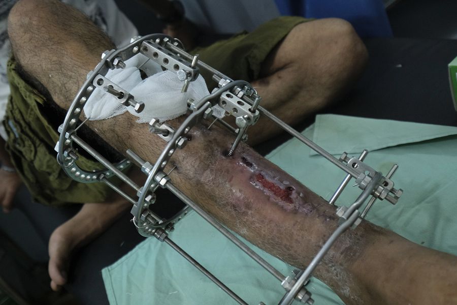 Las heridas suponen años de convalecencia, ya que las balas destrozan huesos y tejido blando