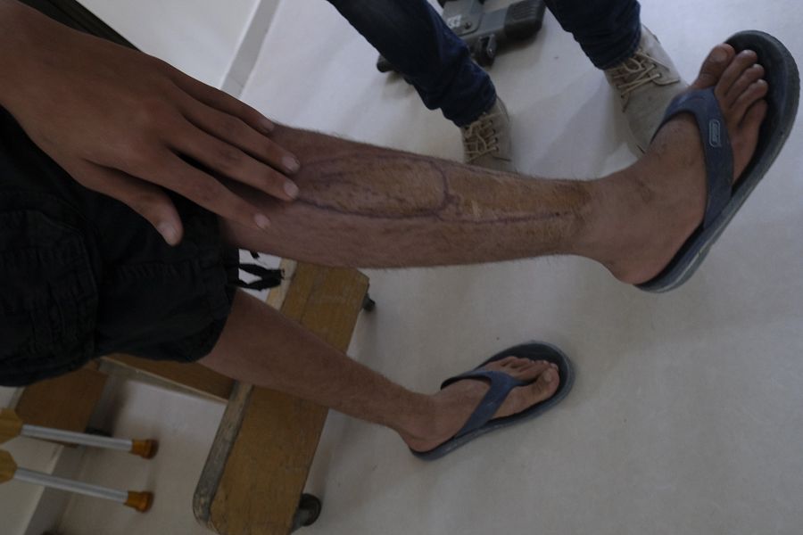 Algunos de los heridos sufrirán secuelas de por vida