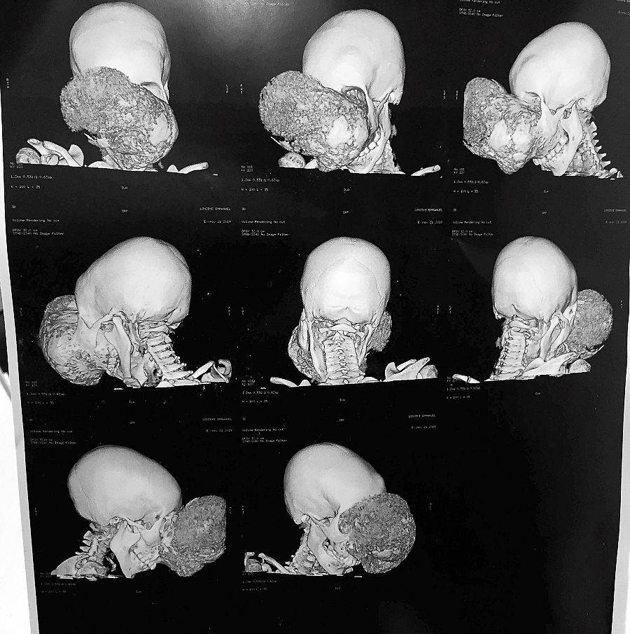 TAC con diferentes imágenes del tumor de Emmanuel antes de la operación.