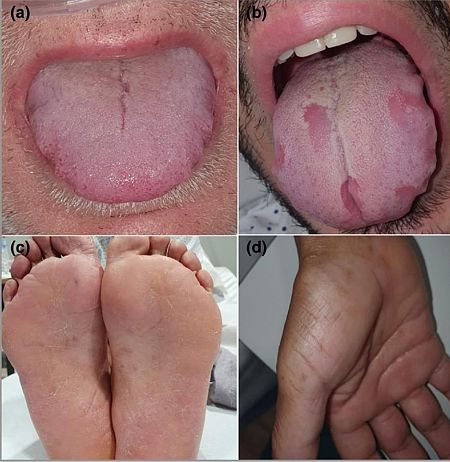 Entre los síntomas de coronavirus, el estudio incluye lesiones en la boca, palmas de las manos y en plantas de los pies.