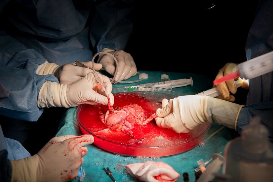 Sanitarios manipulan el útero tras la extracción del cuerpo de la donante.