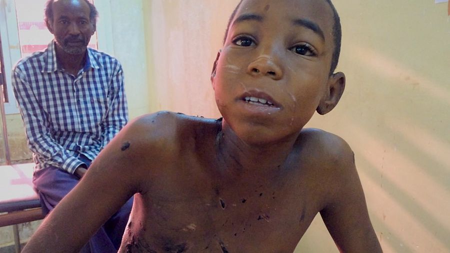 Ismail, niño ingresado en el hospital por graves lesiones sufridas en la escuela coránica