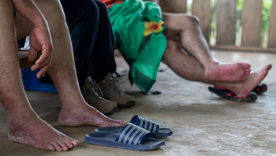 Una de las afecciones más comunes al tratar de cruzar el Darién son las heridas en los pies tras días caminando en una selva tropical