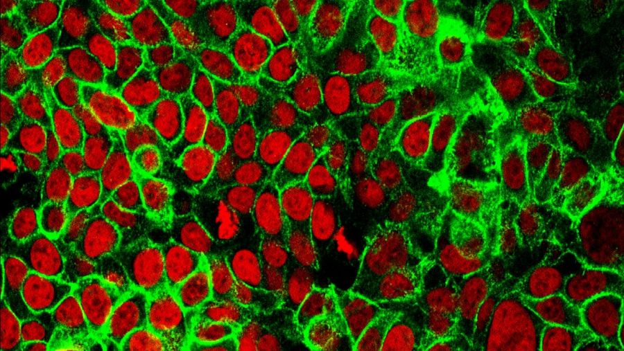 Les cèl·lules de càncer de còlon humà amb els nuclis cel·lulars de color vermell