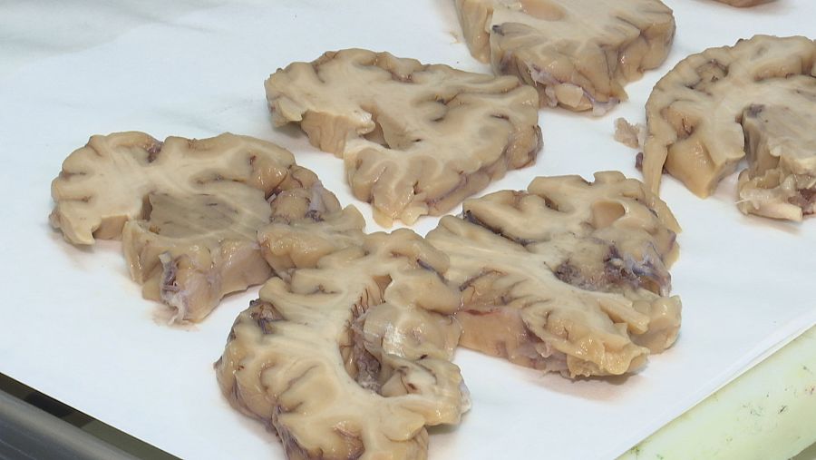 Muestras de un cerebro donado